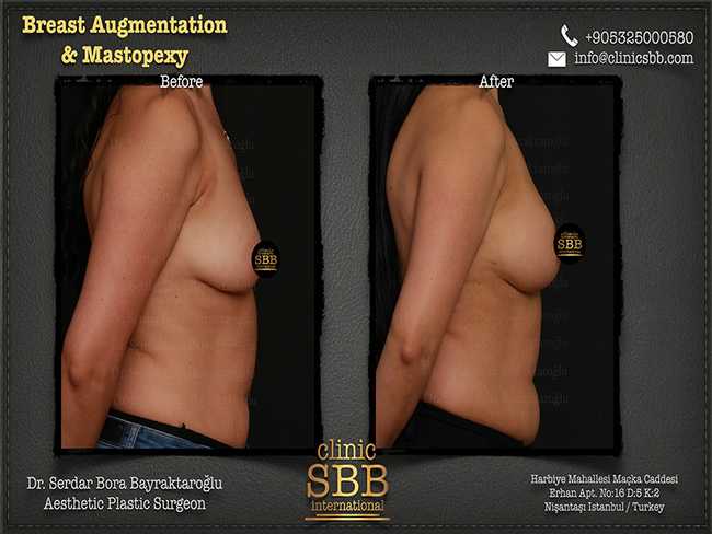 Breast Augmentation Mastopexy Clinic SBB Serdar Bora Bayraktaroglu 9