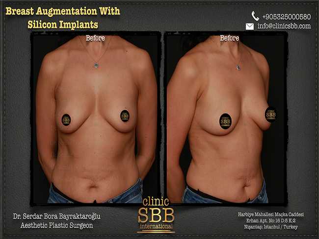 Breast Augmentation Mastopexy Clinic SBB Serdar Bora Bayraktaroglu 6