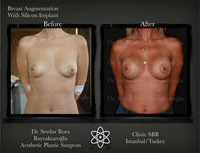 Breast Augmentation Before After Serdar Bora Bayraktaroglu In Istanbul Clinic 14 1