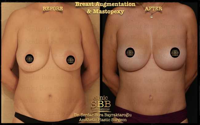 breast augmentation mastopexy before after 11