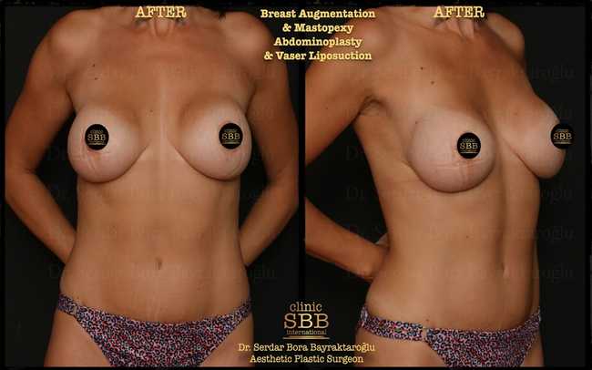 vaser liposuction before after 10