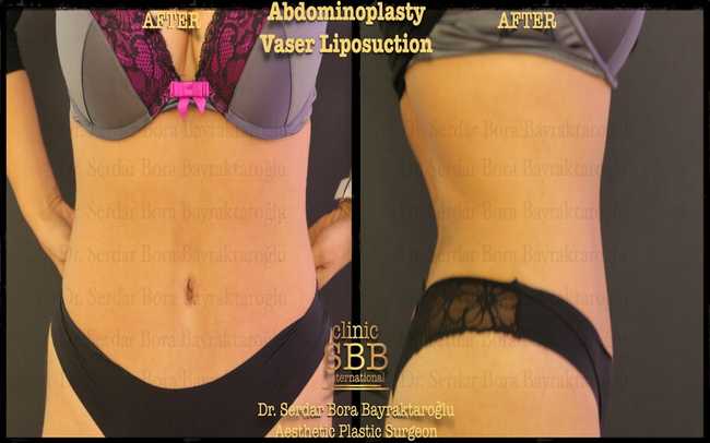 abdominoplasty before after 9