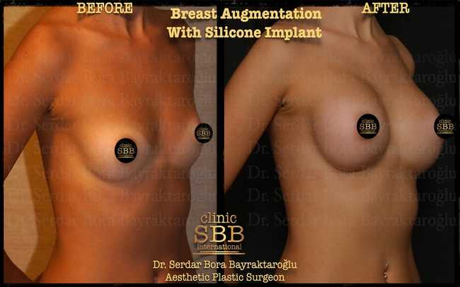 breast augmentation before after 4