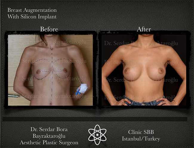 Breast Augmentation Before After Serdar Bora Bayraktaroglu In Istanbul Clinic 6 1