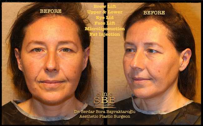 face neck lift before after 11