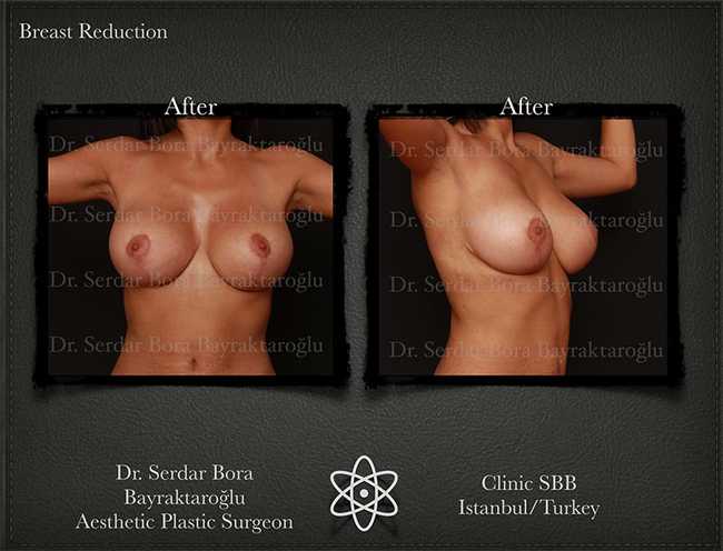 Breast Reduction Before After Serdar Bora Bayraktaroglu In Istanbul Clinic 4