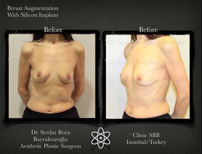 Breast Augmentation Before After Serdar Bora Bayraktaroglu In Istanbul Clinic 9 1