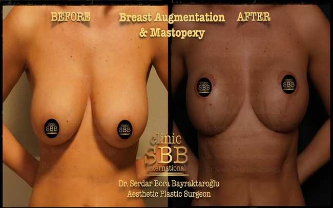 breast augmentation mastopexy before after 7