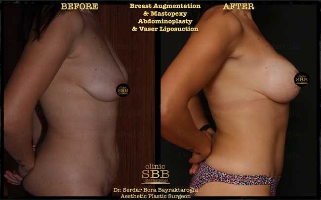 abdominoplasty before after 13