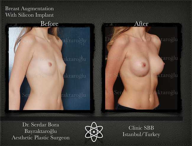 Breast Augmentation Before After Serdar Bora Bayraktaroglu In Istanbul Clinic 3 1