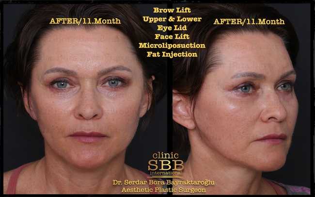 face neck lift before after 10