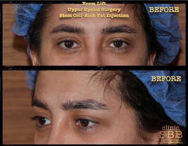 eyebrown lift before after 6