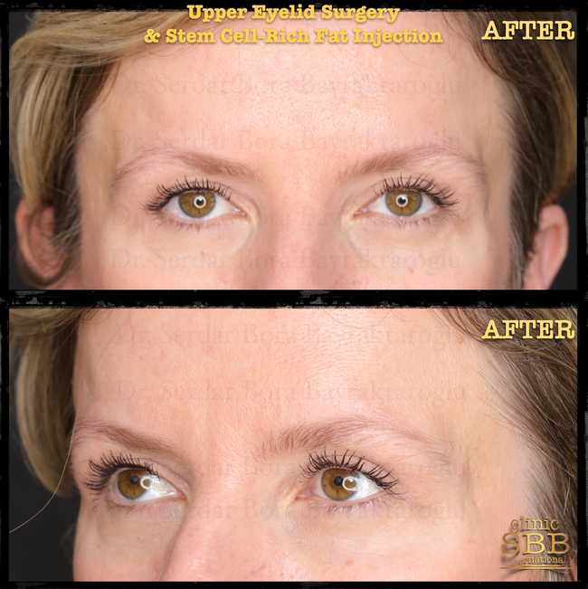upper lower eye lid before after 5