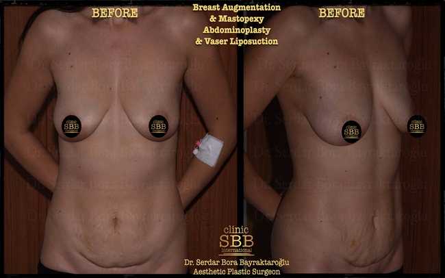 abdominoplasty before after 10