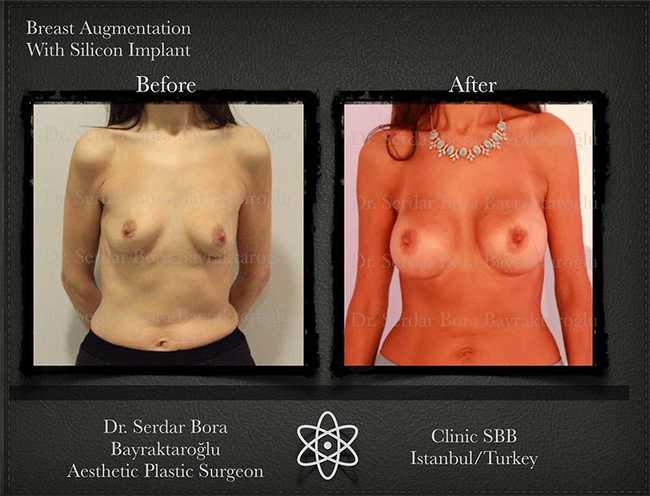 Breast Augmentation Before After Serdar Bora Bayraktaroglu In Istanbul Clinic 10 1