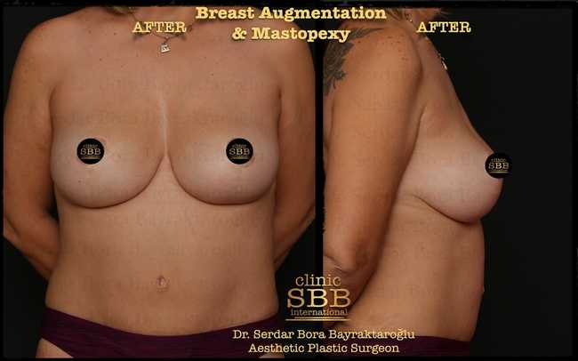 breast augmentation mastopexy before after 13