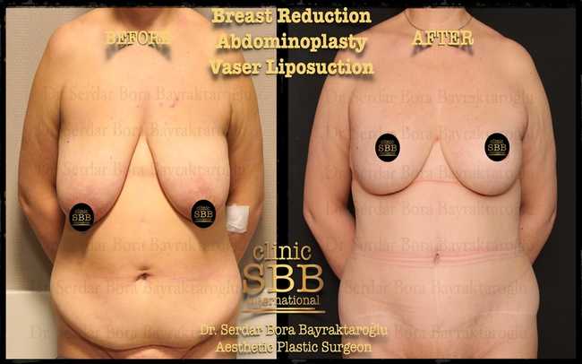 breast reduction before after 4