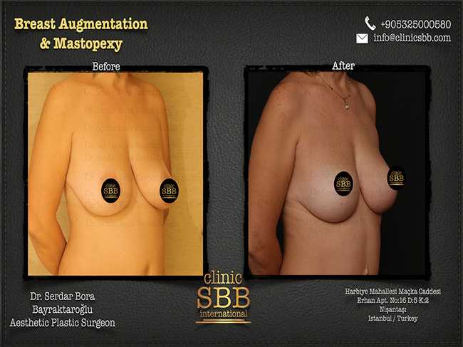 Breast Augmentation Mastopexy Clinic SBB Serdar Bora Bayraktaroglu 13