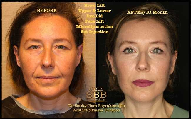 face neck lift before after 12