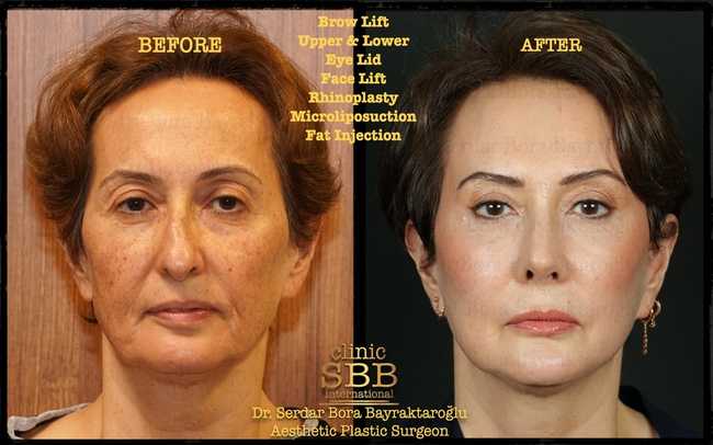 face neck lift before after 1
