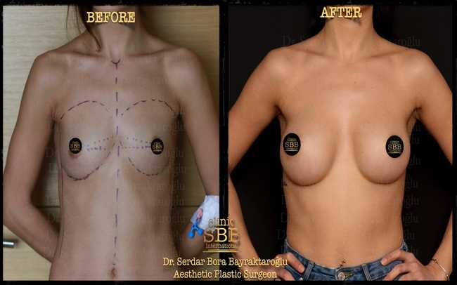 breast augmentation before after 9
