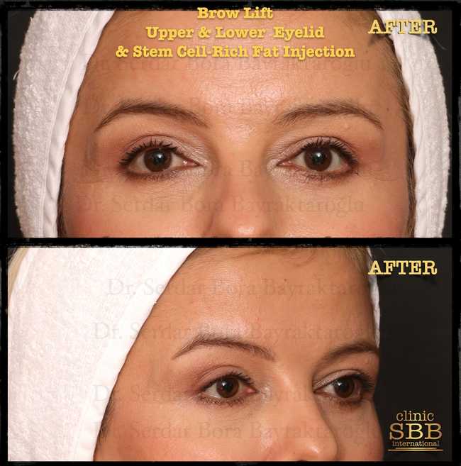 eyebrown lift before after 5