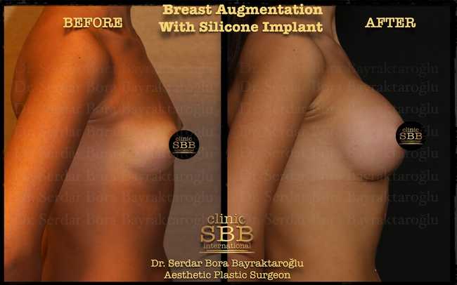 breast augmentation before after 2