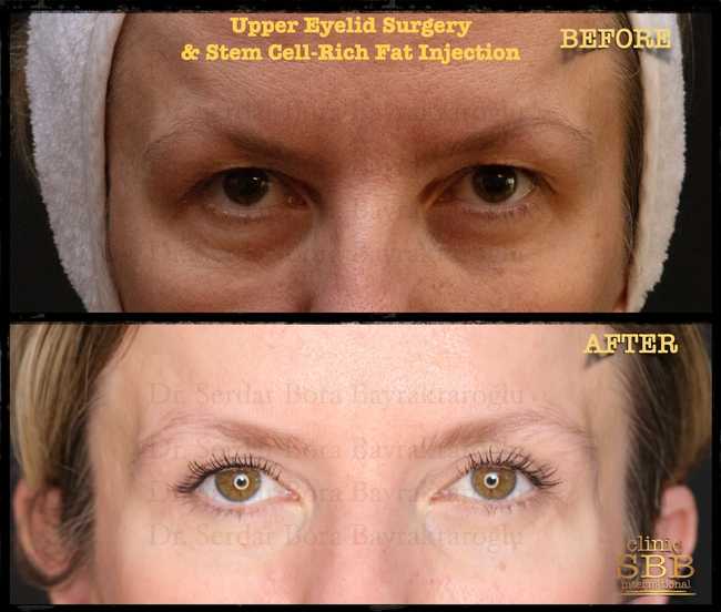 upper lower eye lid before after 2