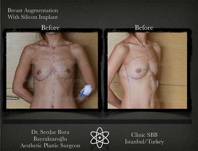 Breast Augmentation Before After Serdar Bora Bayraktaroglu In Istanbul Clinic 5 1