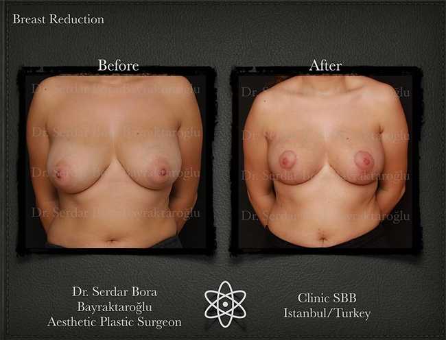 Breast Reduction Before After Serdar Bora Bayraktaroglu In Istanbul Clinic 10