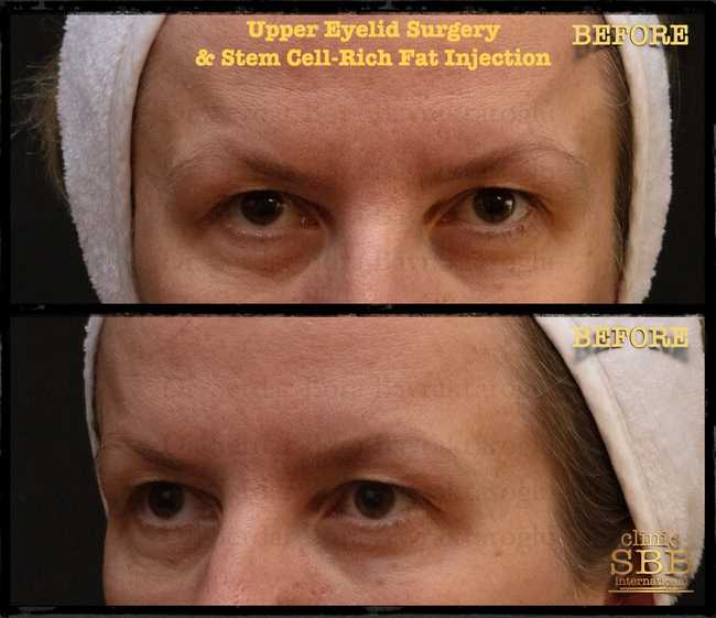 upper lower eye lid before after 1