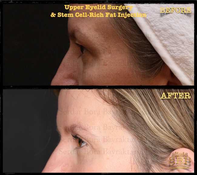 upper lower eye lid before after 4