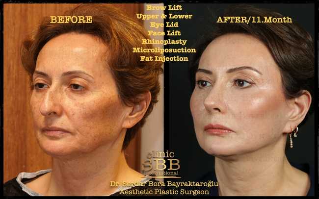 face neck lift before after 2