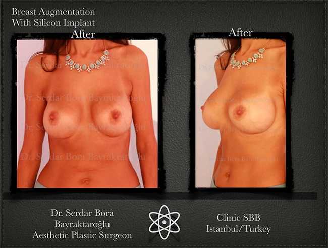 Breast Augmentation Before After Serdar Bora Bayraktaroglu In Istanbul Clinic 12 1