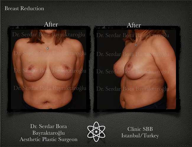 Breast Reduction Before After Serdar Bora Bayraktaroglu In Istanbul Clinic 16