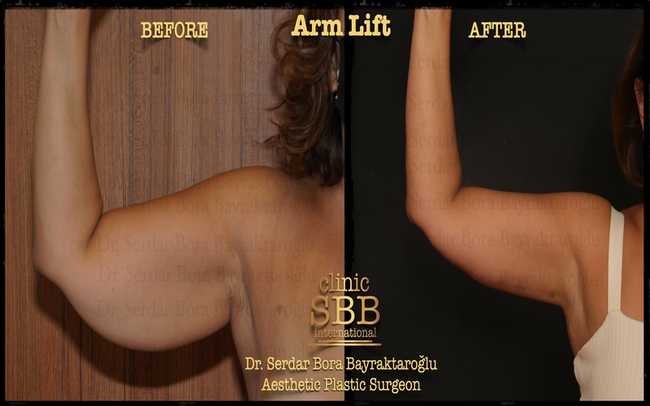 arm leg lift before after 3