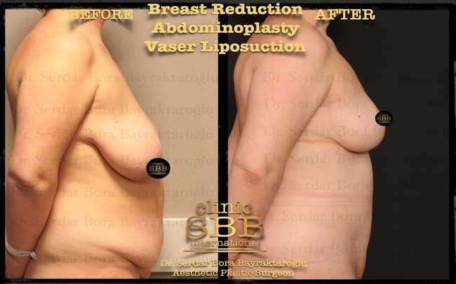 breast reduction before after 2