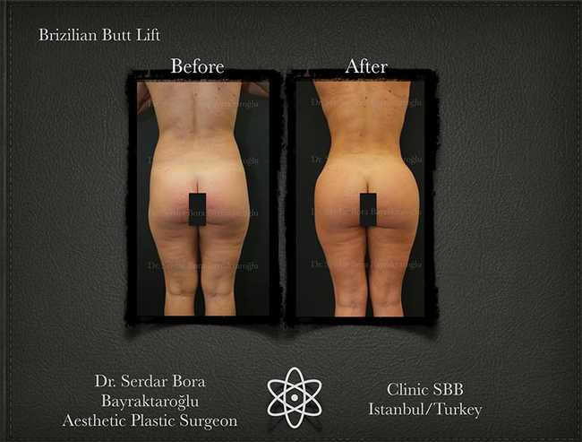 Butt Lift Before After Serdar Bora Bayraktaroglu In Istanbul Clinic 1