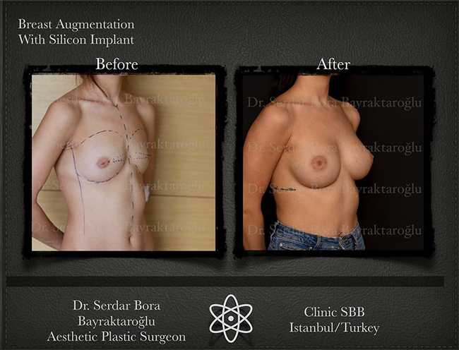Breast Augmentation Before After Serdar Bora Bayraktaroglu In Istanbul Clinic 7 1
