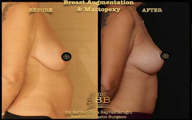 breast augmentation mastopexy before after 12