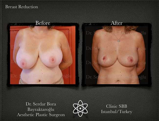 Breast Reduction Before After Serdar Bora Bayraktaroglu In Istanbul Clinic 6