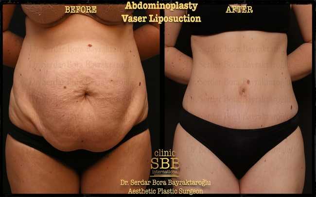 abdominoplasty before after 2