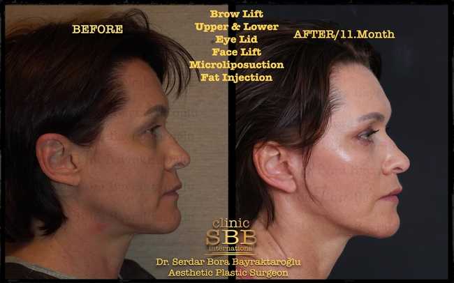 face neck lift before after 9