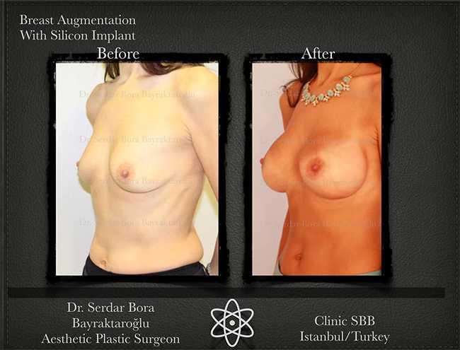 Breast Augmentation Before After Serdar Bora Bayraktaroglu In Istanbul Clinic 11 1