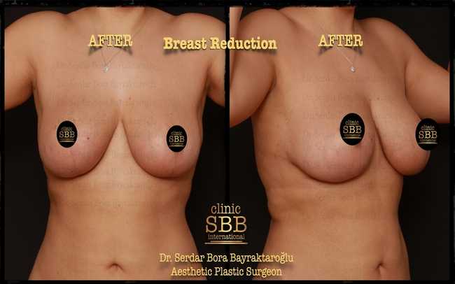 breast reduction before after 9