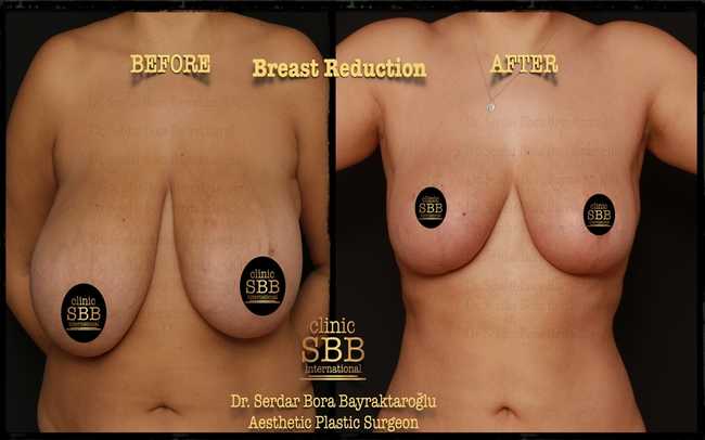 breast reduction before after 5