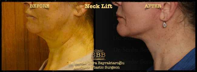 face neck lift before after 17