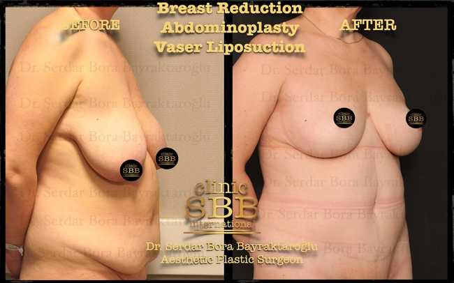 breast reduction before after 3