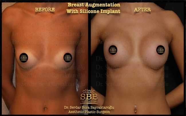 breast augmentation before after 5