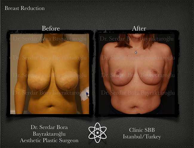 Breast Reduction Before After Serdar Bora Bayraktaroglu In Istanbul Clinic 14